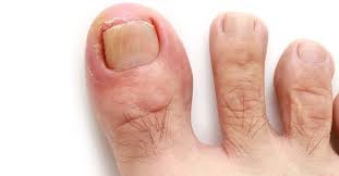 When Should I Consult a Healthcare Professional about Toenail Issues