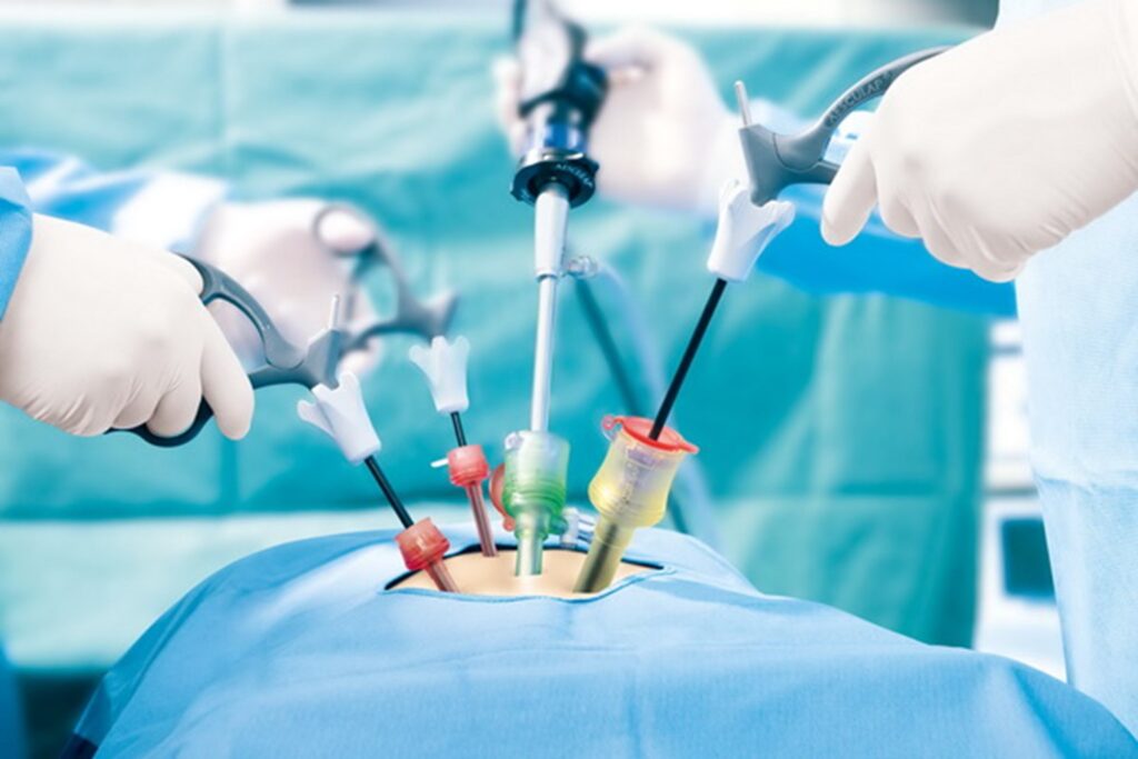 Laparoscopy-for-Trеating-Infеrtility