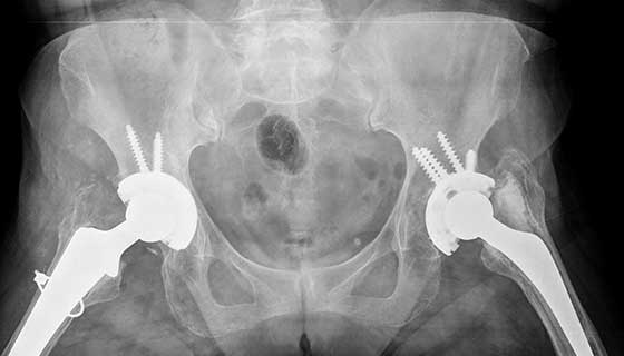 Hip replacement surgery in Rajouri Garden 