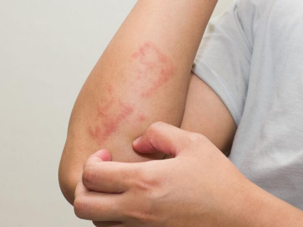 Oral Lichen Planus Treatment